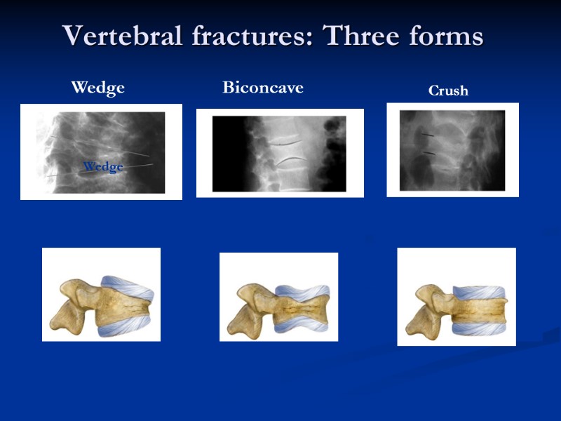 Vertebral fractures: Three forms Wedge Biconcave Crush Wedge